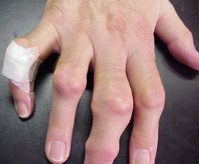 palce z deformacjami stawów powodują ból