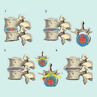 etapy rozwoju osteochondrozy szyjki macicy