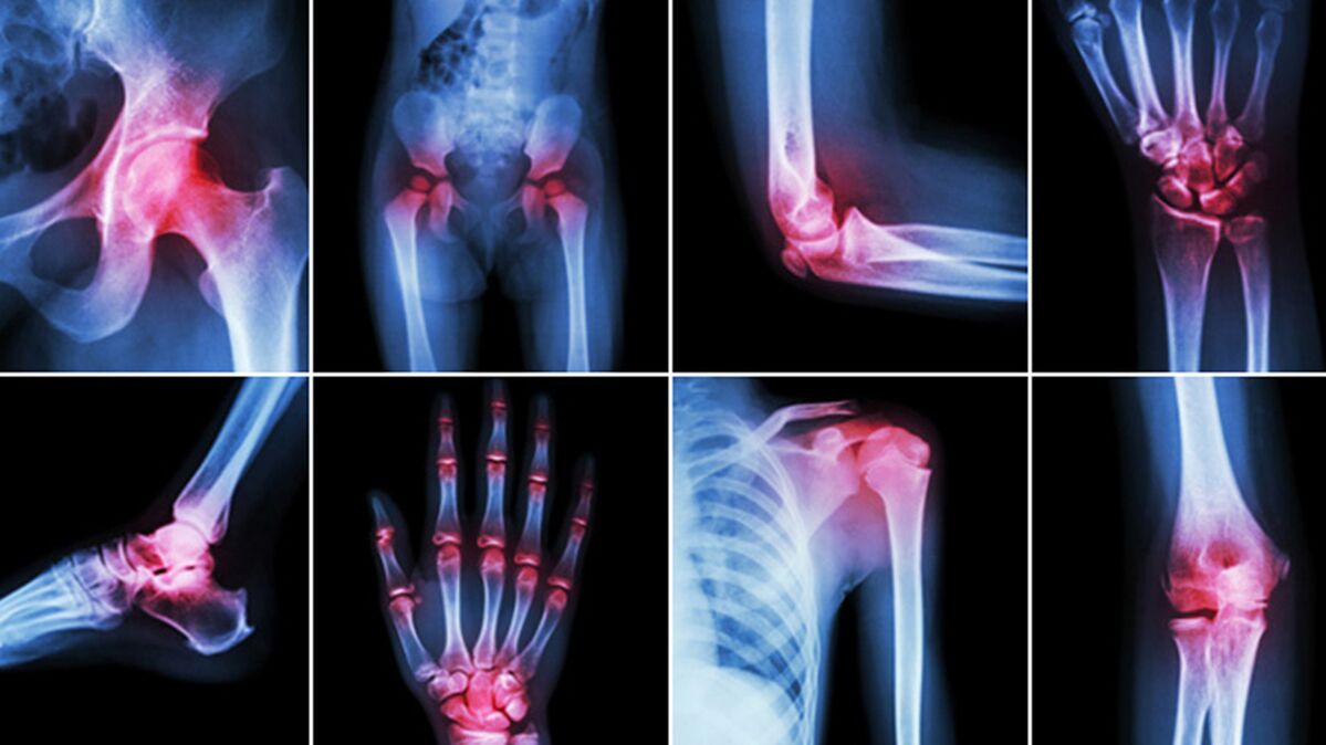 Zdjęcia rentgenowskie na ból stawów