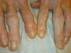 Choroba zwyrodnieniowa stawów drobnych stawów rąk