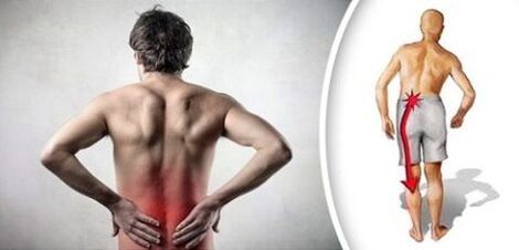 Zespół bólu z osteochondrozą lędźwiową promieniuje na nogi