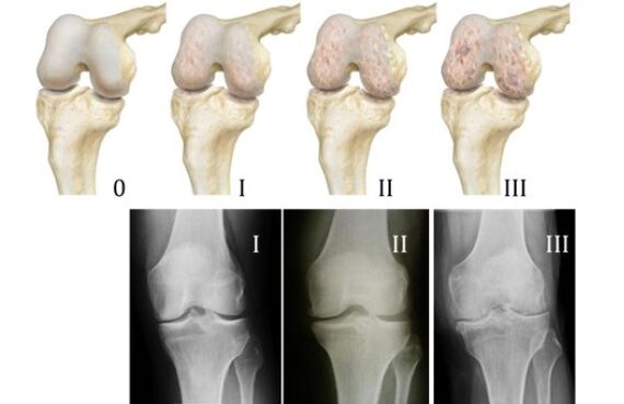 Metody diagnostyki artrozy stawu kolanowego